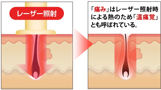 メンズ医療脱毛のしくみ