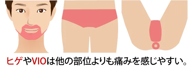 メンズ医療脱毛のしくみ